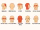 Infografía de las zonas de dolor de cabeza: migraña, tensión, ATM, hipertensión y sinusitis